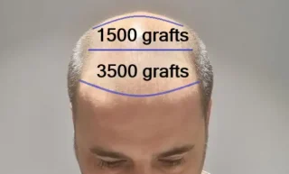 5000 greft saç ekimi fiyatı