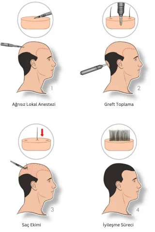FUE saç ekimi aşamaları